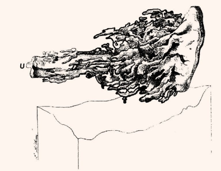 Image 3: Visualization of the anterior configuration where prostatic tissue is most concentrated near the external urethral opening.