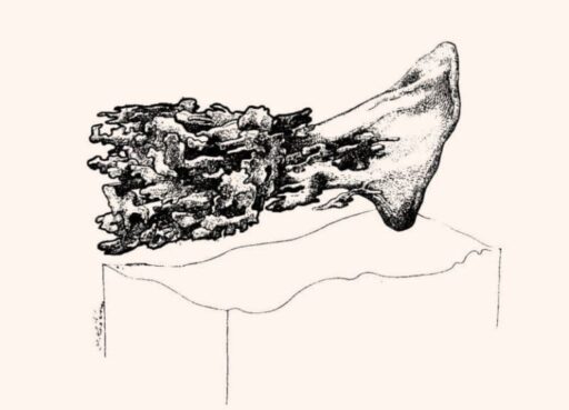 Image 4: Representation of the posterior prostate type where the largest portion of glandular tissue sits near the bladder neck.