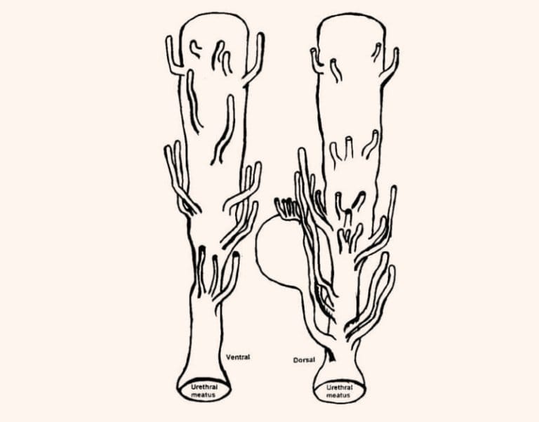 Image 6: Detailed view of multiple paraurethral ducts entering the urethral canal at various points instead of external openings.