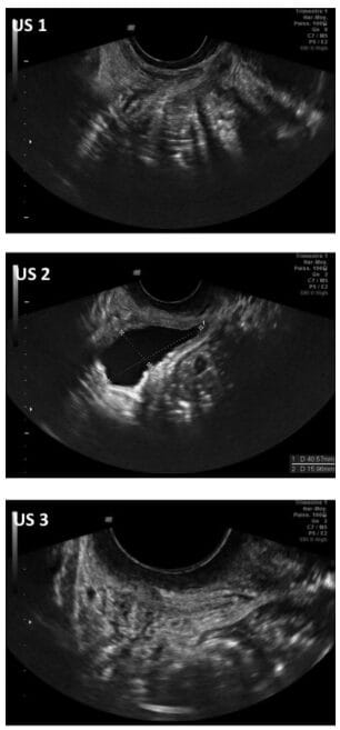 Pelvic ultrasound imaging showing varying bladder filling states during the examination demonstrates the urinary origin of squirt. US1 = completely empty bladder after spontaneous voiding; US2 = full bladder after sexual stimulation; US3 = ​​empty bladder after squirt.